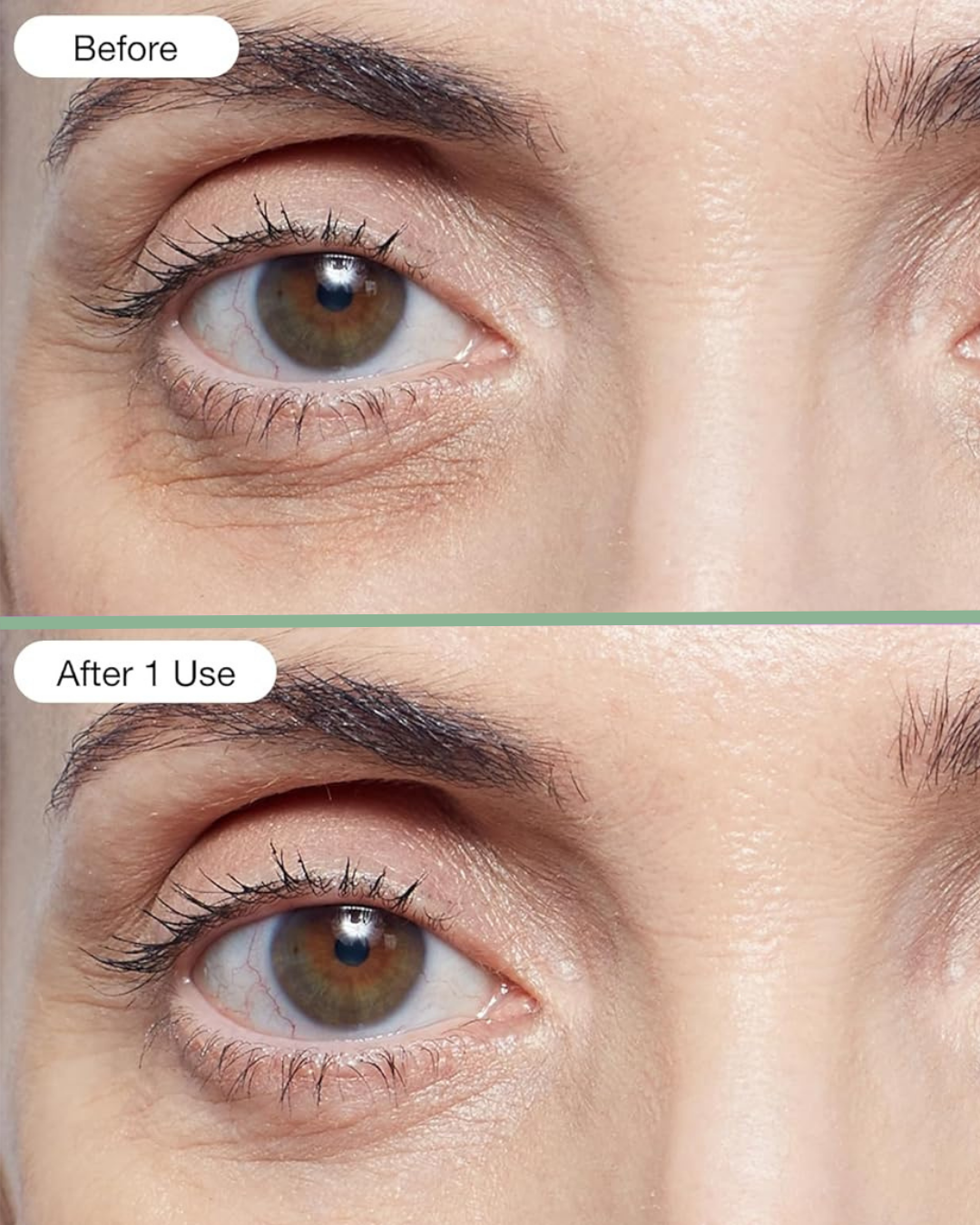 Undereye Hydrogel Patch