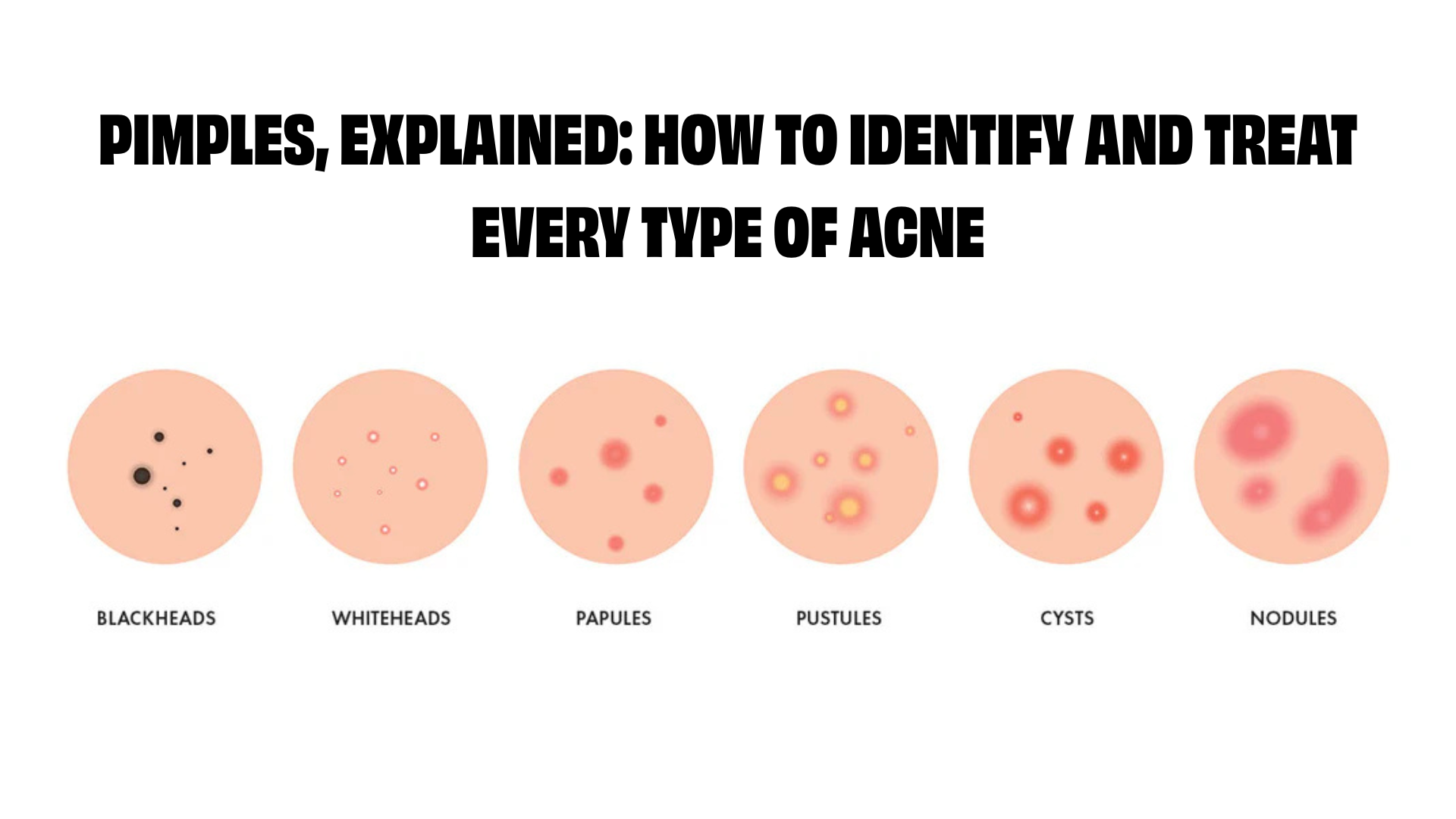 Pimples, Explained: How to Identify and Treat Every Type of Acne
