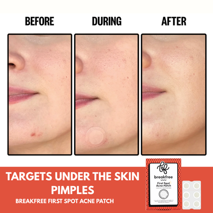 First Spot Acne Patch