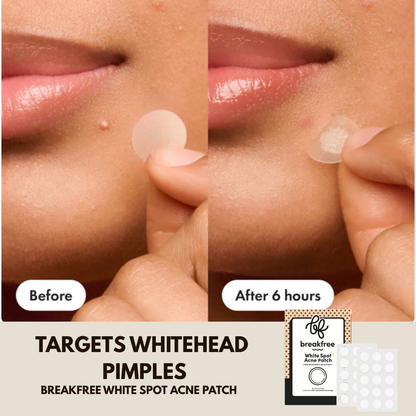 White Spot Acne Patch